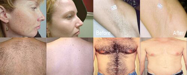 Ipl hair removal soprano diode laser skin hair removal ipl machine ipl light