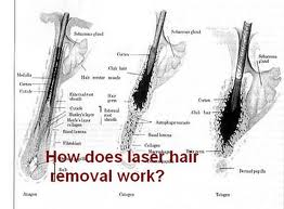 Germany laser bars OEM / ODM permanent 808 hair removal system devices