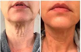Endolift Laser For Hips Say Goodbye To Under Eye Bags And Achieve Youthful Results