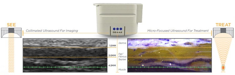 HIFU Face Lift Machine Types Of Heads 1.5mm / 3.0mm / 4.5mm Screen Size 15 Inch 300W Power