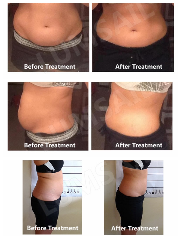 Cryolipolysis Fat Freezing Body Slimming Machine No Surgery For Body Slimming