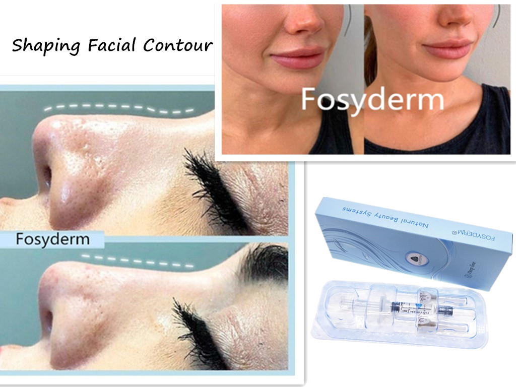 Facial Hyaluronic Acid Dermal Filler With Syringe For Lip Nose Chin Cheek 24mg