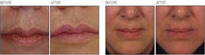 Perioral Wrinkles