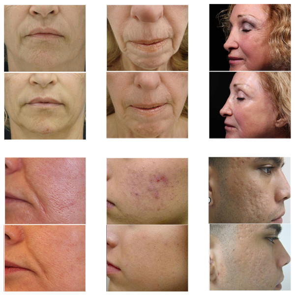 cpt skin rejuvenation machine fractional microneedle radiofrequency