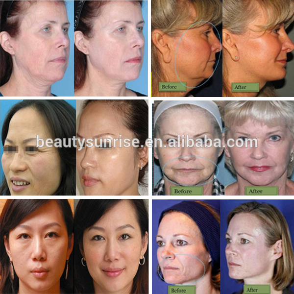 hifu face lifting.jpg