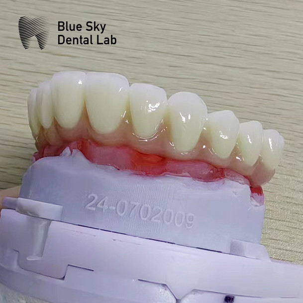 Dental Multi Implant Cases Customized Implant Procedure Cases