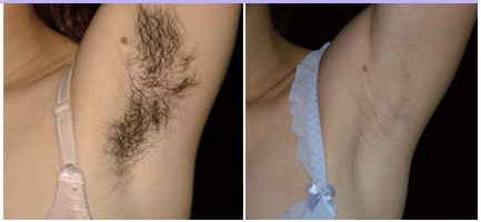 4 In 1 Nd Yag Laser Machine , Elight IPL Diode Laser Hair Removal Machine