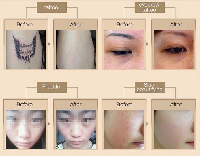 beijing sunrise Newest tattoo removal picosure laser