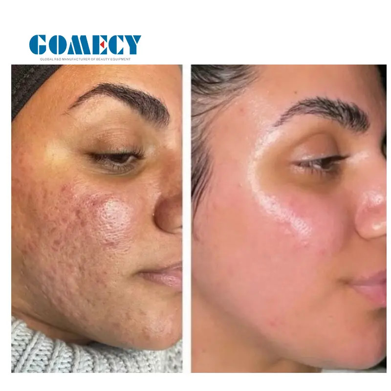 Portable Morpheus8 Machine Fractional Radiofrequency Microneedling Machine