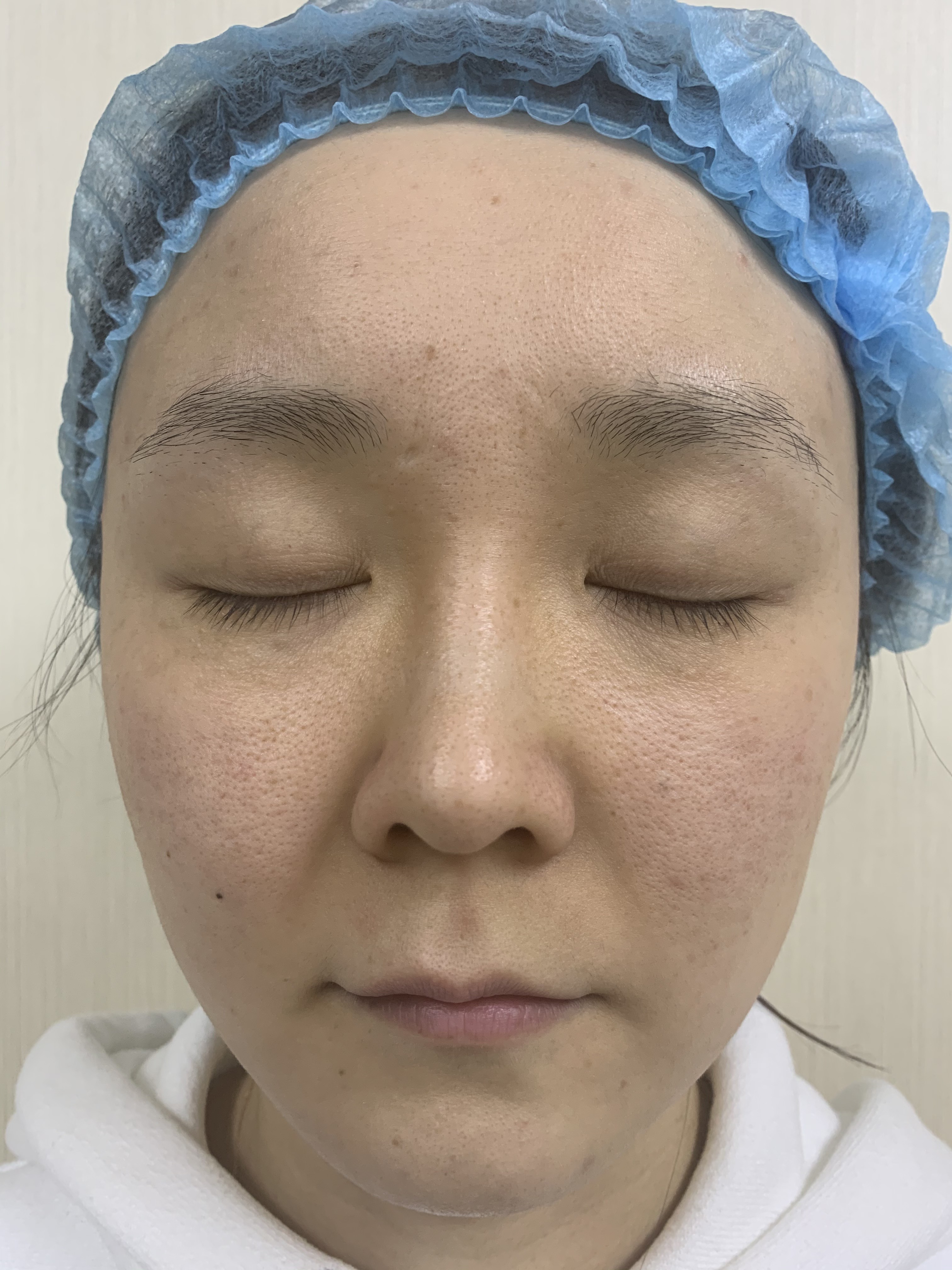 15kg RF Microneedling Machine Skin Tightening Dual operation mode