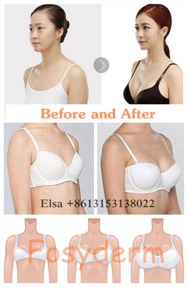 Fosyderm Injectable Dermal Filler Subskin Breast Buttock Enlargement 10ml 20ml