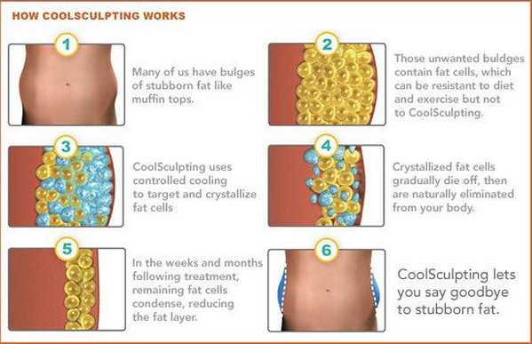 cryolipolysis machine-how it works.jpg