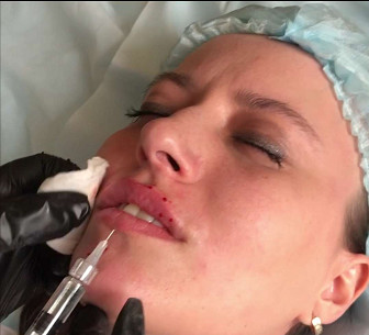 Facial Hyaluronic Acid Dermal Filler / Injectable Hyaluronic Acid Gel Long Lasting