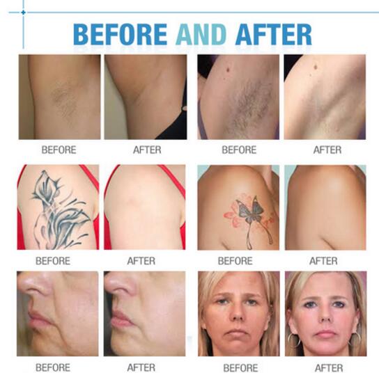 2 handles SHR E-light IPL Freckle Removal/Acne Removal/SHR IPL Hair Removal