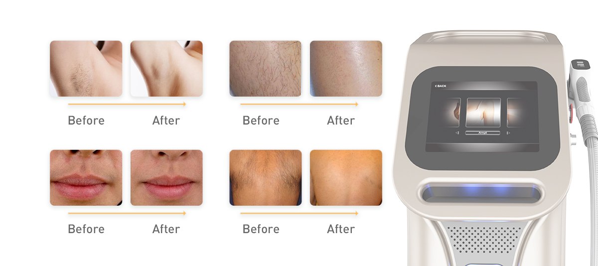 Ice Platinum 2000W 808Nm Diode Laser System Professional Painless Permanent Laser Hair Removal Machines