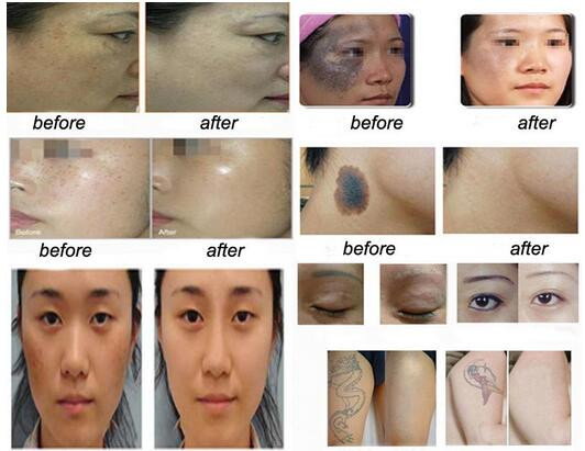 Factory price Q-switch 1064nm Nd Yag Laser Tattoo Removal / Freckle dispelling machine