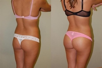 20ml Dermal Fillers For Buttocks Hyaluronic Acid Dermal Filler Hydrogel Injections