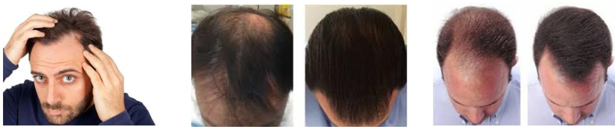5ml Youth Serum Injection Head Skin Care PRP Injection For Hair Growth