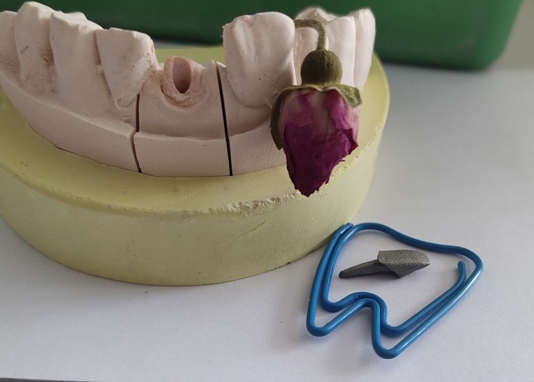 Metal Dental Post And Core After Endodontic Treatment