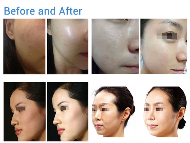 ADSS New Designed Skin Care Mesotherapy Hydro Lifting Mesogun Injector