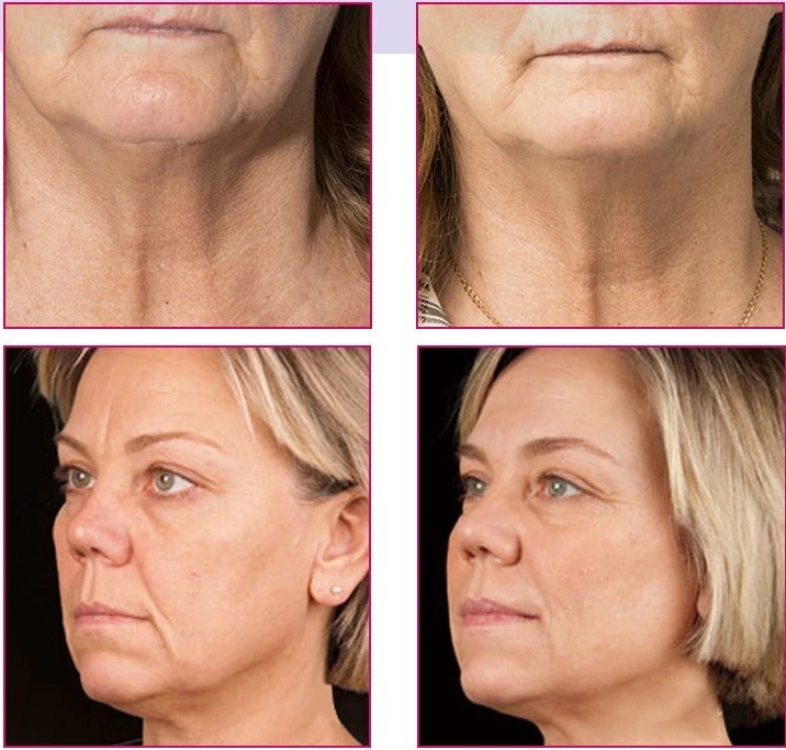 Fosyderm Wrinkle Removal Dermal Filler Injectable For Under Eye