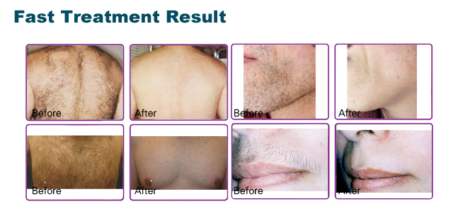Professional and effective skin rejuvenation /freckle removal IPL SHR Hair Removal machine