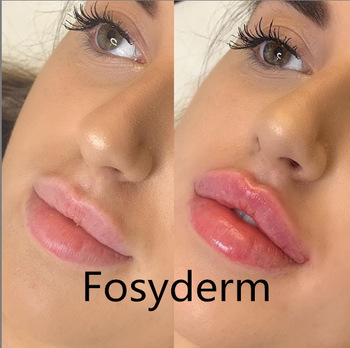 Hyaluronic Acid Injector Dermal Lip Fillers Injectable For Lip Enhancement Gel