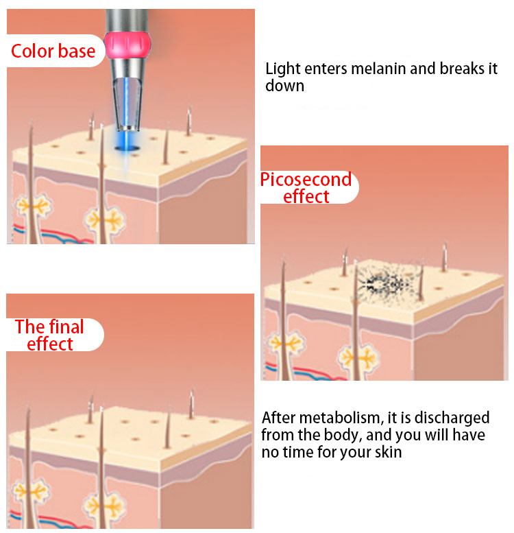Medical Q Switched Nd Yag Laser Machine , Beauty Laser Tattoo Removal Machine