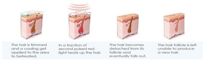Permanent 808nm Diode Laser Depilation Machine Hair Removal Laser Equipment