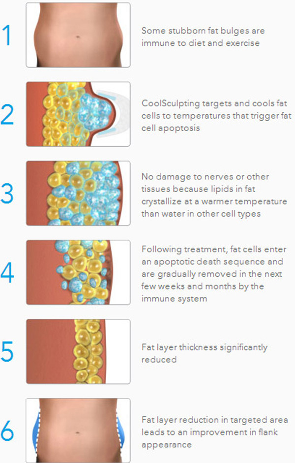 Cellulite treatment machine Cryotherapy Slimming Machine With Different Handles