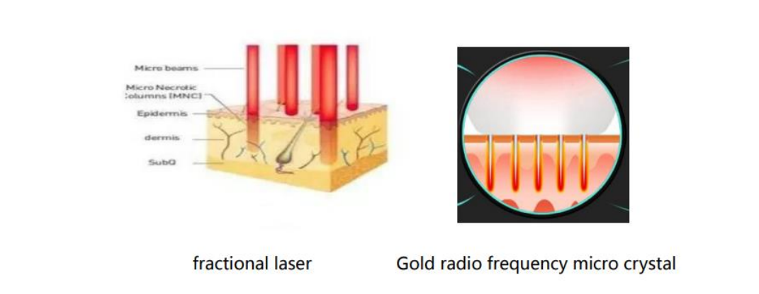 Cold Harmmer Fractional Rf Microneedle 2 In 1 Machine For Facail Lifting