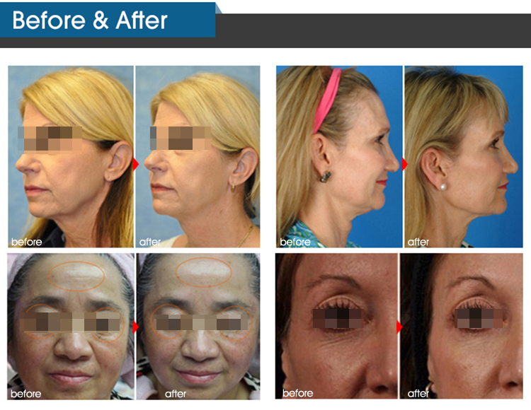 ADSS Skin Rejuvenation Hifu Beauty Machine CE