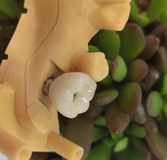 Cemented Implants Crowns Bridges