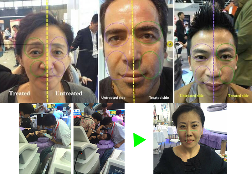 Professional beauty salon use Good price Hifu High Intensity Ultrasound Face Lift Machine with gray color 15 inch screen
