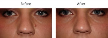 Skin Warts Removal Fractional CO2 Laser / Vaginal Tightening Machine CE Certificate