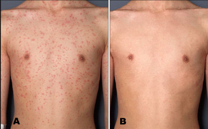 Handheld Psoriasis Light Therapy Equipment , UV Light Treatment For Vitiligo