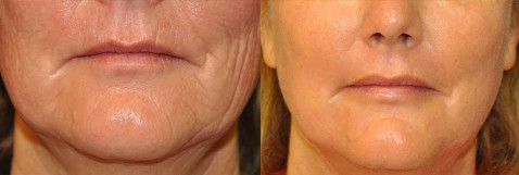 Skin Resurfacing CO2 Fractional Laser Machine For Epidermis Resurfacing / Wrinkle Reduction