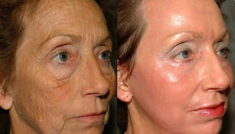 Skin Resurfacing CO2 Fractional Laser Machine For Epidermis Resurfacing / Wrinkle Reduction