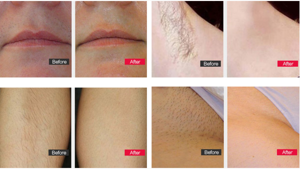 Portable Ipl Machine For Skin Rejuvenation Permanent Hair Removal Device