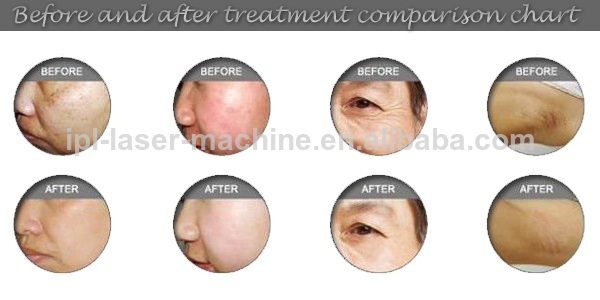 Newest and hot sell high frequency IPL laser hair scar removal Skin lighten machine