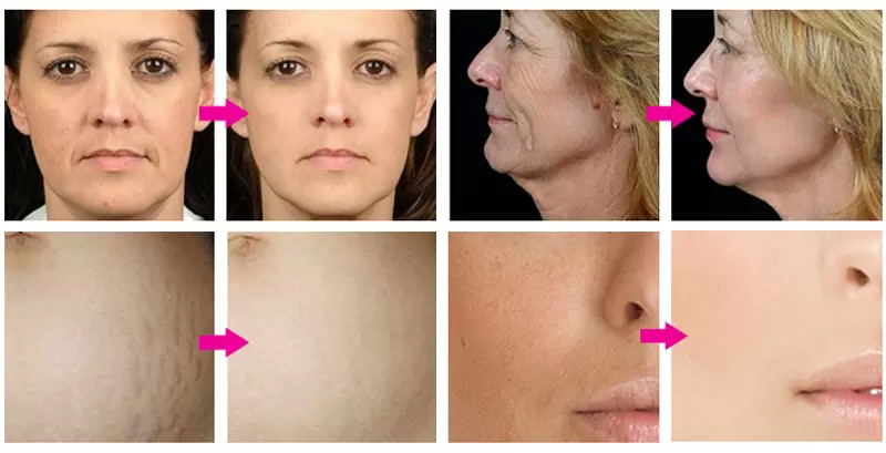 Anti Aging Fractional RF Microneedling Machine Radio Frequency 2 In 1 MRF SRF