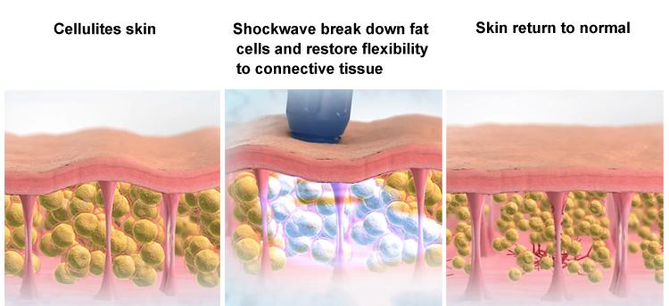 Build In Silence Powered Air Compressor Shockwave Therapy For Ed Treatment
