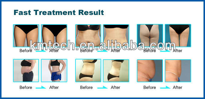 Portable Lipo Laser Slimming Beauty Machine Radio Frequency 40k Cavitation Slimming Machine
