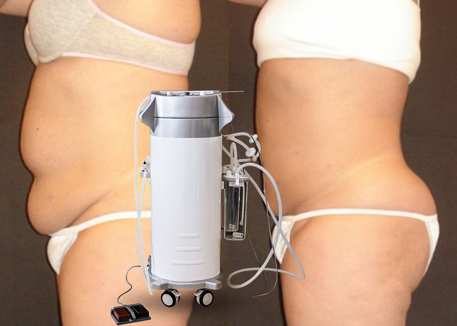 BS-LIPS5 300W Power Assisted Liposuction Equipment For Neck Breast And Chin