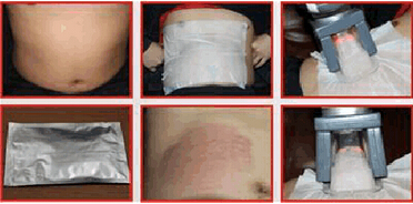 Cryolipolysis nubway for weight loss portable home cryolipolysis liposuction machine