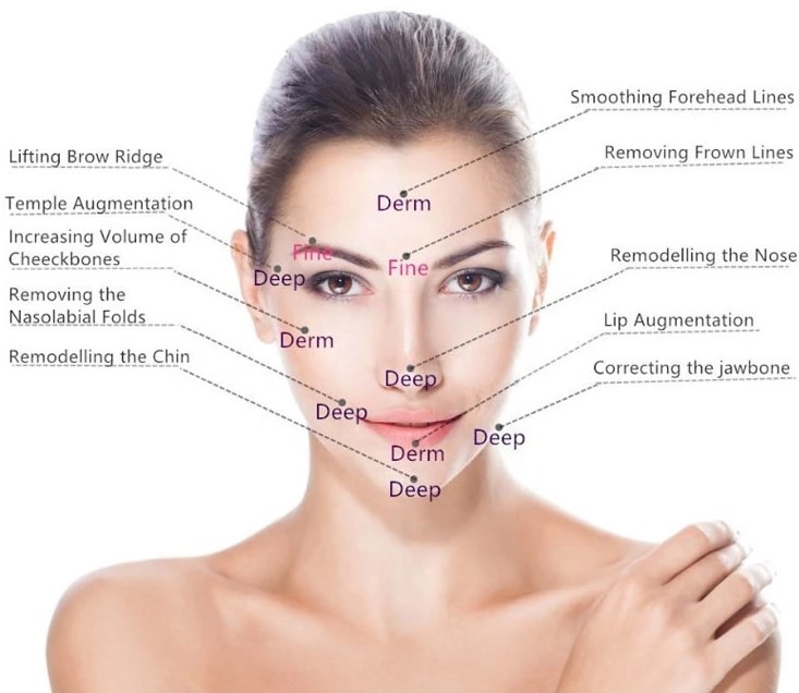 Fosyderm Wrinkle Removal Dermal Filler Injectable For Under Eye