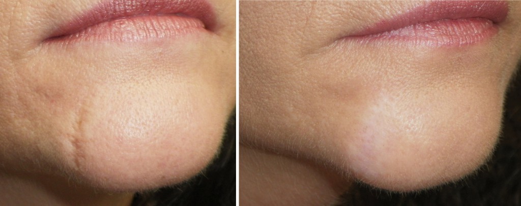 Safety CO2 Acne Scar Removal Machine , Carbon Dioxide Laser Resurfacing Machine