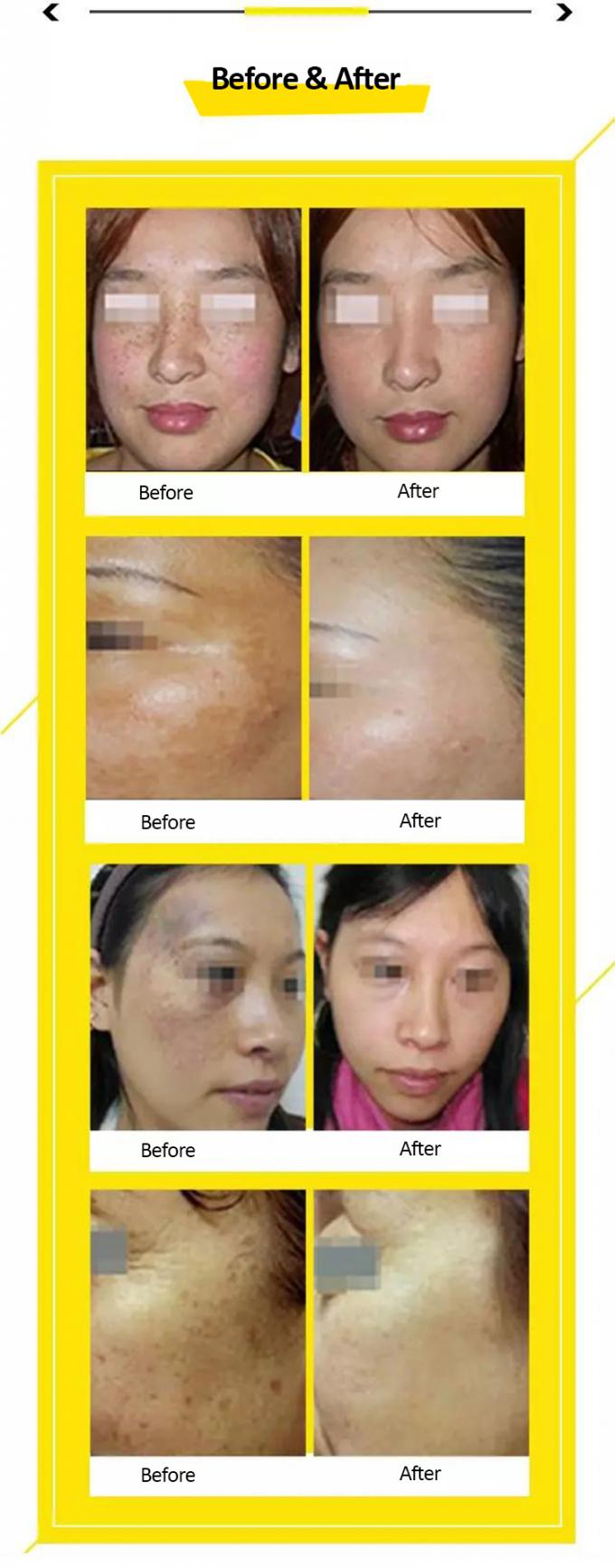 Picosecond Laser Tattoo Removal 1064nm&532nm Device With Korean 7 Joint Articulated Arm 1