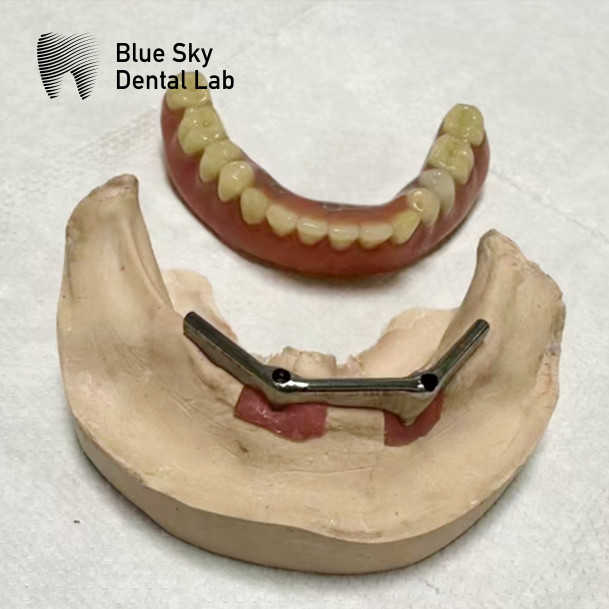 Blue Sky Implant Titanium Bar Dental For Implant Dentures