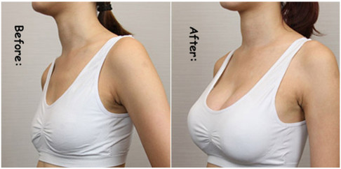 1ml Breast Filler Hyaluronic Acid 24mg/Ml For Wrinkles Nasolabial Grooves Body